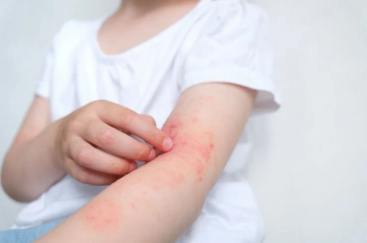 Eczema Management