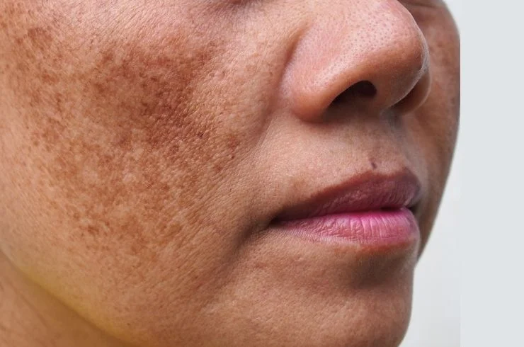 Melasma and Pigmentation Solutions