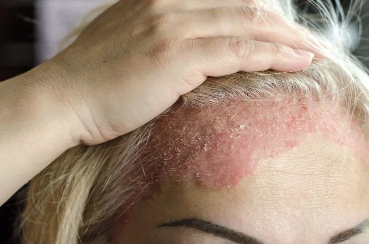 Psoriasis Treatment